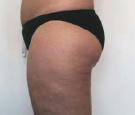 cellulite treatment nyc after